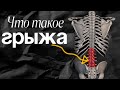 Грыжа под контролем! Эффективные методы борьбы и профилактики