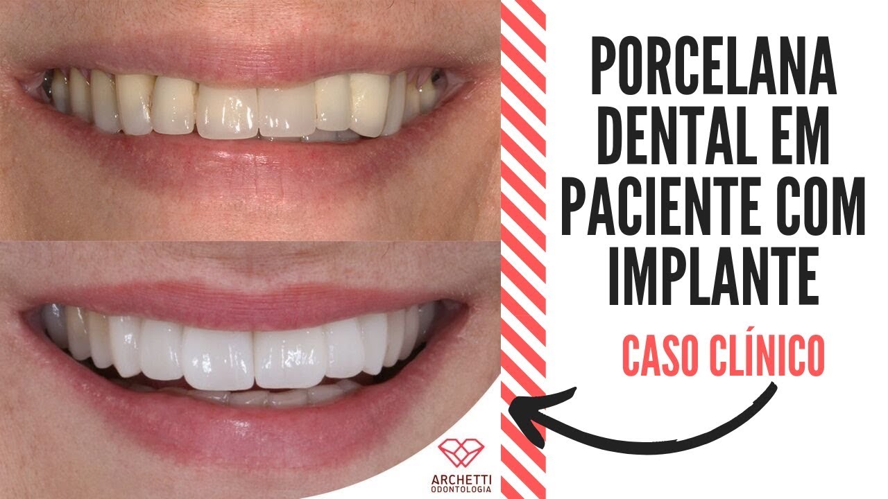 Porcelana Dental em paciente com implante dentário Antes e Depois