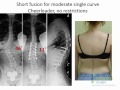 What to Expect: Returning to Full Function after Scoliosis Surgery