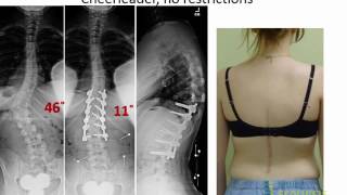 What to Expect: Returning to Full Function after Scoliosis Surgery