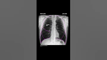 Lung Anatomy On A Chest X Ray Shorts 
