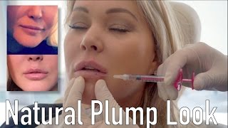 Natural Plump Look with Volbella Filler ft. Shanna Moakler