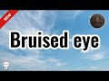Bruised eye - KaTa Studio Official 