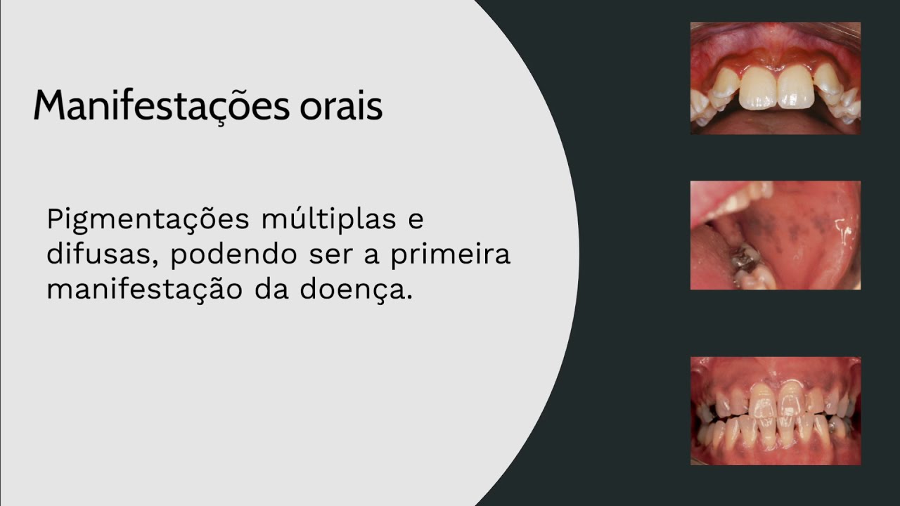Doença de Addison - OdontoCards - YouTube