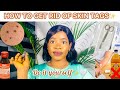 HOW TO REMOVE SKIN TAGS YOURSELF SAFELY |Home Remedy *How To Get Rid Of Skin Tags* + Do It Yourself