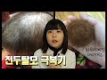 나의 전두탈모 극복기 (feat. 자라나라 머리머리)