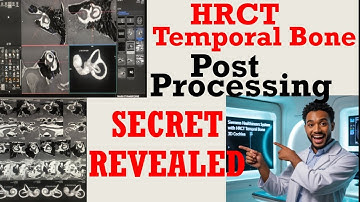 3D Important Images | Post Process HRCT Temporal Bone | Inner Ear Scan #medicos1k86 #radiology #ct
