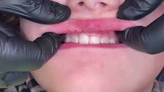 Why look at a dental frenum? by Hygiene Edge 3,645 views 3 months ago 42 seconds