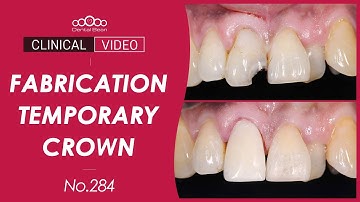 #11 crown preparation and Temporary crown setting [Dr. Na Kiwon]