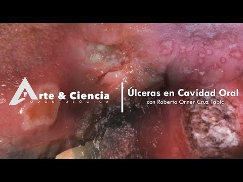 Video: Cómo tratar las úlceras de garganta (con imágenes)