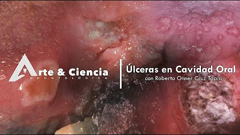 ¿Cuánto dura una úlcera oral?