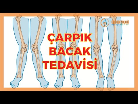 ÇARPIK BACAK SORUNLARI VE ÇARPIK BACAK TEDAVİLERİ