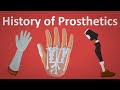 The History Of Prosthetics Explained