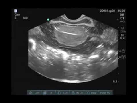 Video: Ultrasound Rahim - Ciri, Hasil