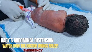 Abdominal Distension in Newborns Explained – Doctor’s Procedure and Baby’s Recovery!”