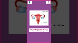 Can Removing Fibroids Help You Get Pregnant? - Dr Charishma Chandh Yadav K | Doctors' Circle