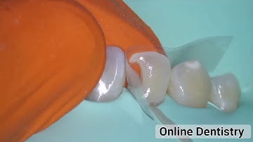 class III composite restoration "mastering class 3 free hand technique"