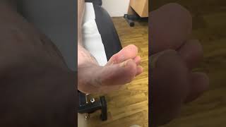 Painful Corn Between Toes Removal In Podiatry Clinic