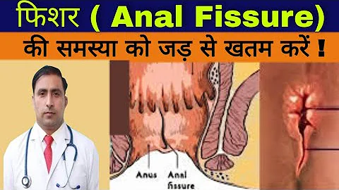 फिशर ( Anal Fissure)की समस्या को जड़ से खतम करें ! || Dr Kumar education clinic