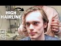&quot;I&#39;m Looking For A Haircut That Works For My HIGH HAIRLINE&quot; | Talking Hair Loss EP 4