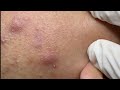Inflammatory Acne On Cheeks | Mụn Viêm Trên Má - SacDepSpa#129