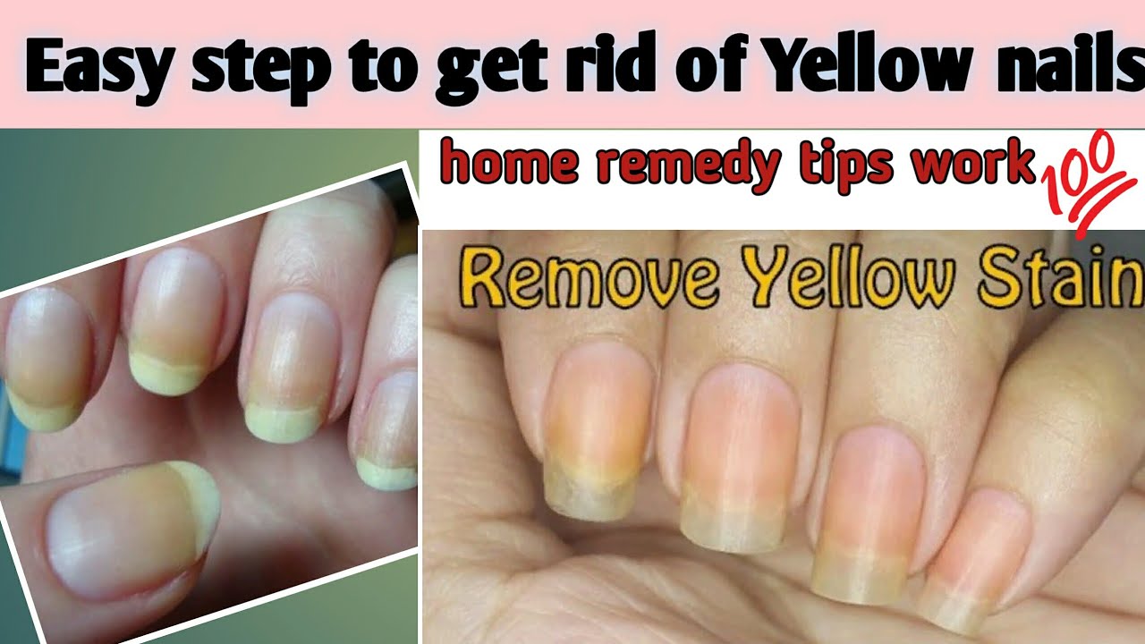 Get rid of Yellow nails Remove Yellow Stain tips by Sehrish Ansari