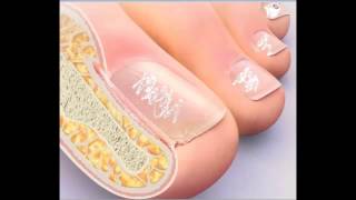 White Fungus Toenails