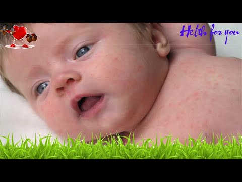 Saúde -  Como saber o que é Alergia na pele do bebê e o que fazer
