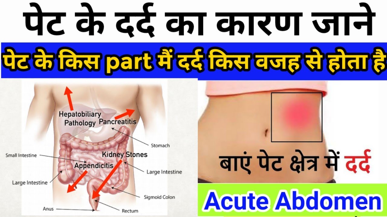 पेट के किस part मैं किस वजह से pain होता है || Acute abdomen || Stomach pain causes