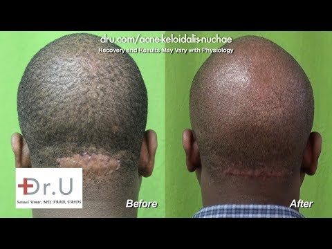 Razor Bumps Back of Neck, Barber&#;s Rash Back of Head, Acne Keloidalis Nuchae Cure