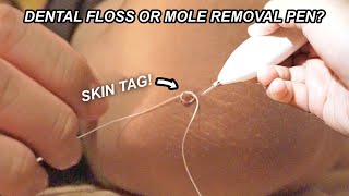 Can You Remove a Skin Tag With Dental Floss?  