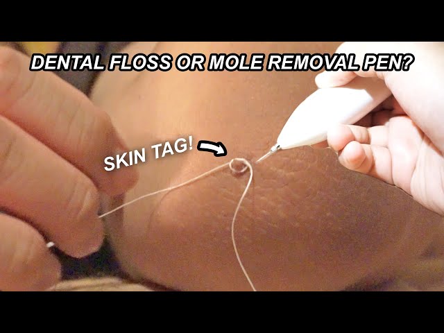 HOW TO REMOVE SKIN TAGS (3 WAYS) - YouTube