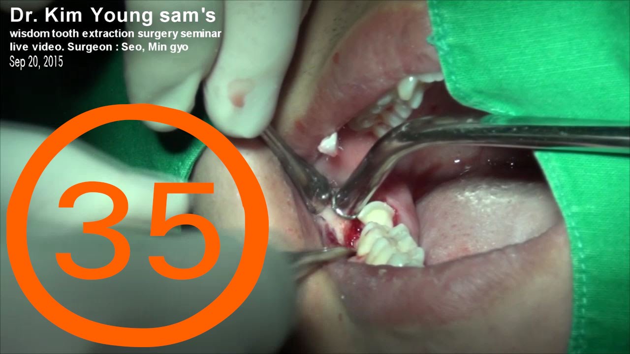 35th video #18, #48 Surgical extraction of lower horizontal impacted wisdom teeth  - Dr. Seo Min gyo