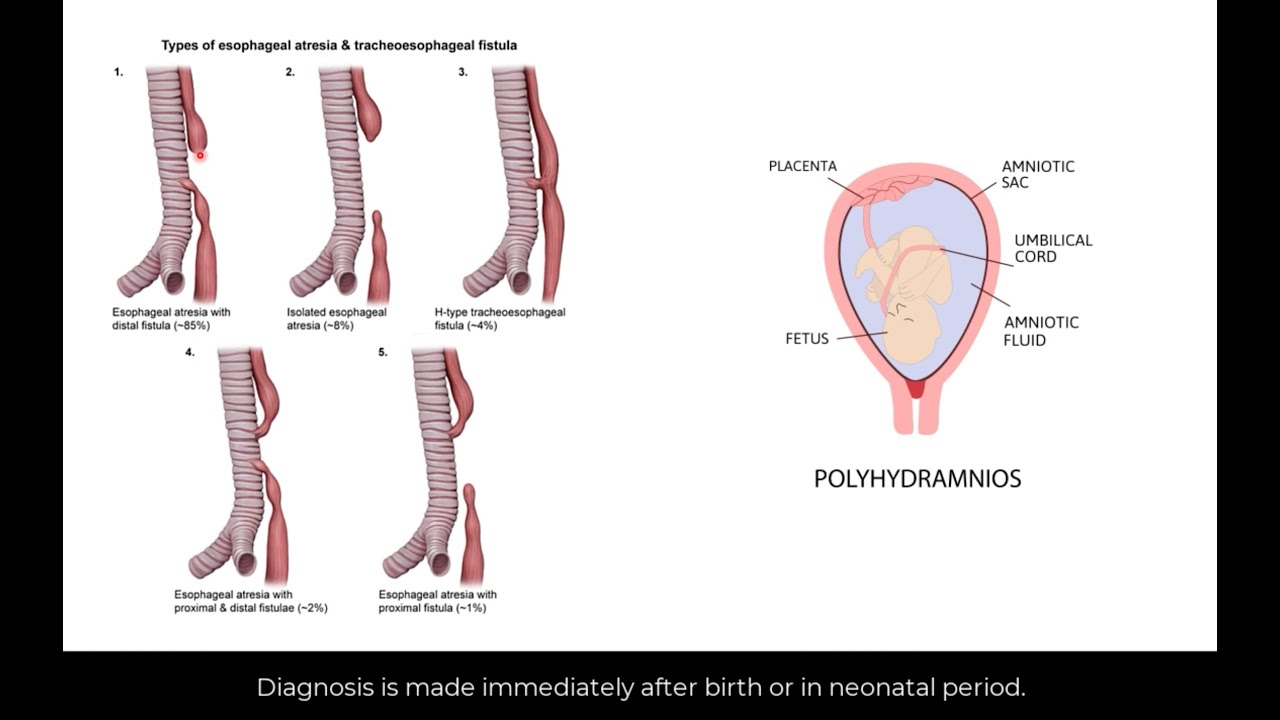 Types of esophageal atresia and tracheoesophageal fistula YouTube