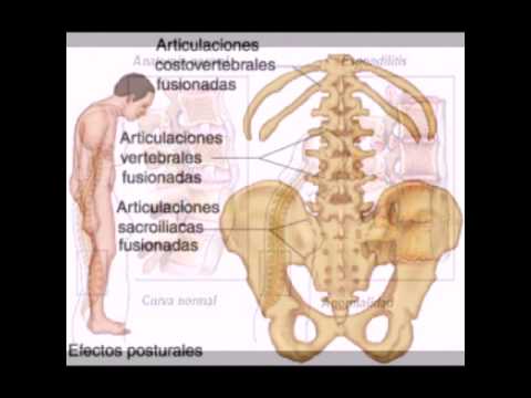 hla b27 cura para la diabetes