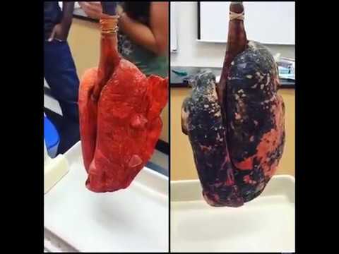 Smokers Lungs VS. Non-smokers Lungs