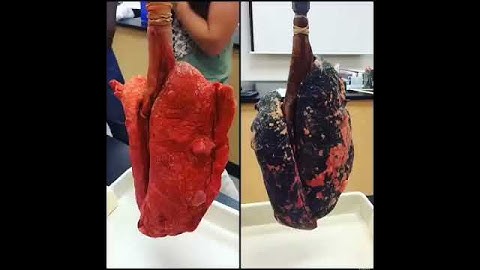 Smokers Lungs VS. Non-smokers Lungs