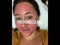 Microneedling  collagen induction therapy