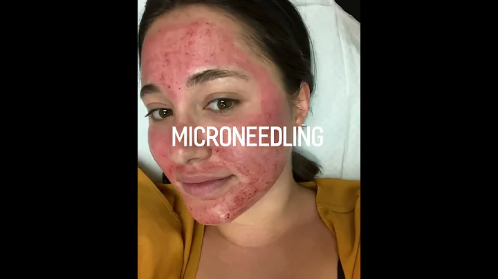 MicroNeedling - Collagen Induction Therapy