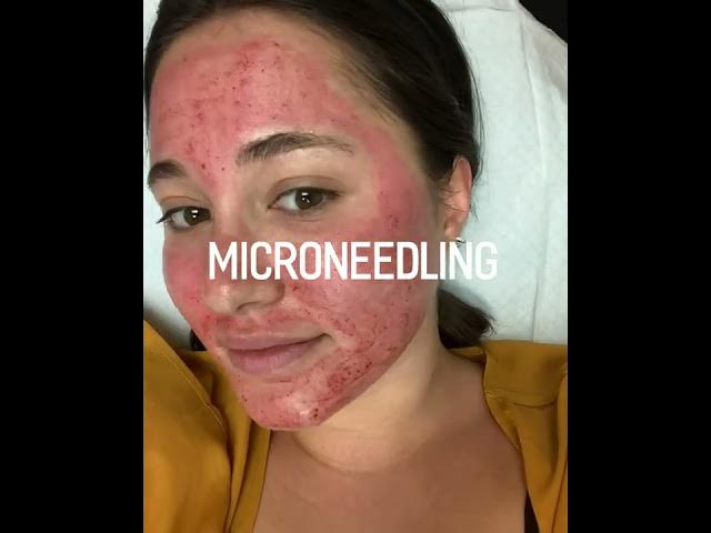 MicroNeedling - Collagen Induction Therapy