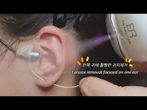 ASMR) Real Series_  한쪽 귀에 몰빵한 귀지제거_  Earwax removal focused on one ear_  片耳集中の耳垢除去