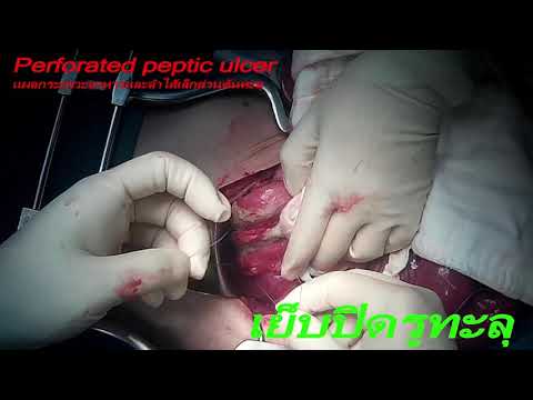 กระเพาะทะลุ แผลกระเพาะอาหารและลำไส้เล็กส่วนต้นทะลุ Perforated peptic ulcer | ข้อมูลที่อัปเดตใหม่เกี่ยวกับรูป กระเพาะ อาหาร