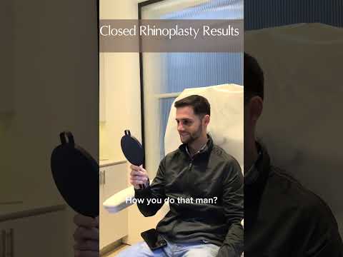 Video thumbnail: Rhinoplasty Results Two Weeks Post-Op #plasticsurgerybeforeandafter #rhinoplastyspecialist · Albert Plastic Surgery New York