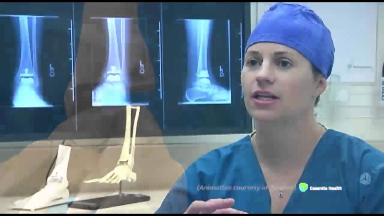 Medical Insight Total Ankle Essentia Health YouTube