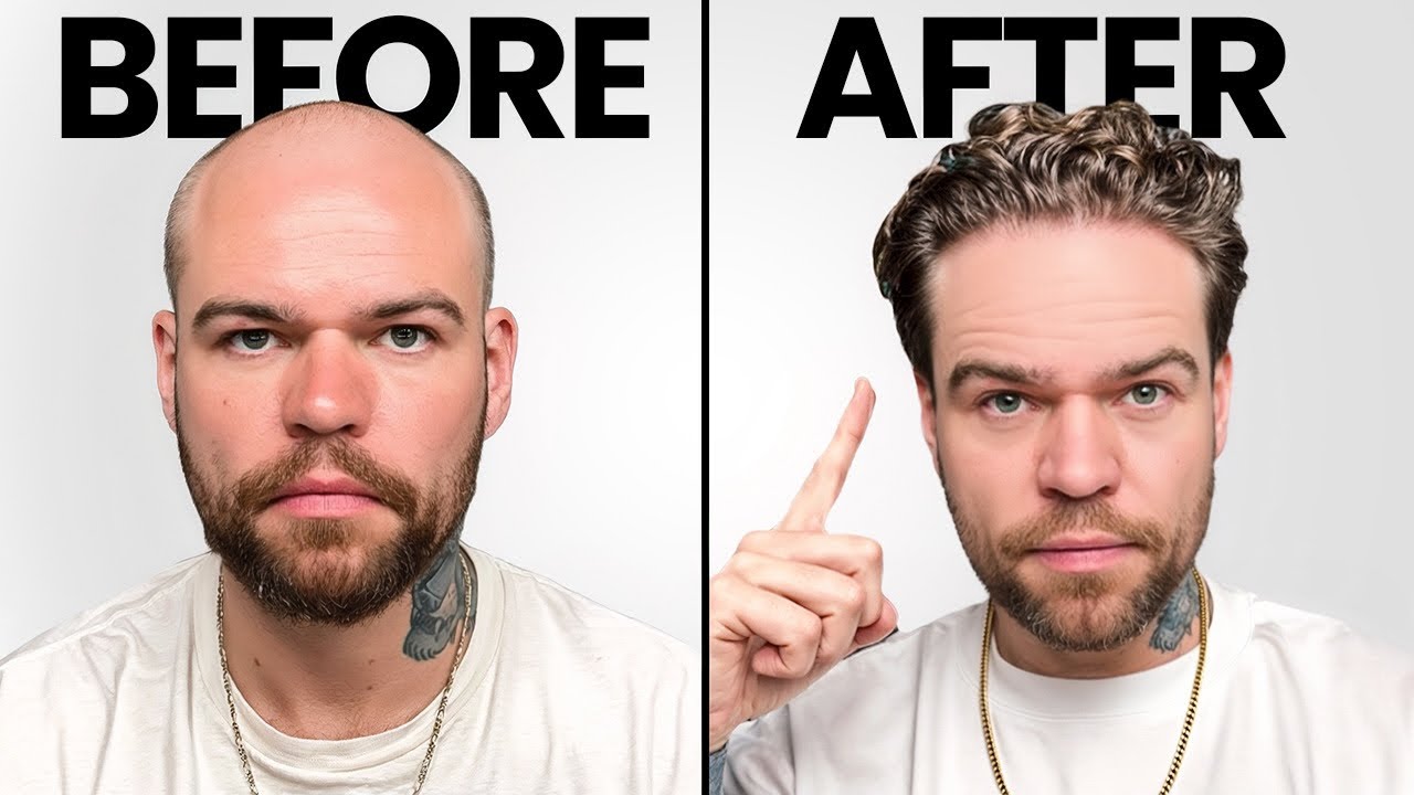 Мне сделали турецкую пересадку волос! До, во время и после.