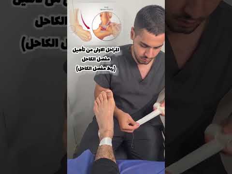 أهمية ربط مفصل الكاحل في تأهيل التواء مفصل الكاحل  