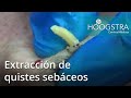 Extracción de quistes sebáceos (19013c)