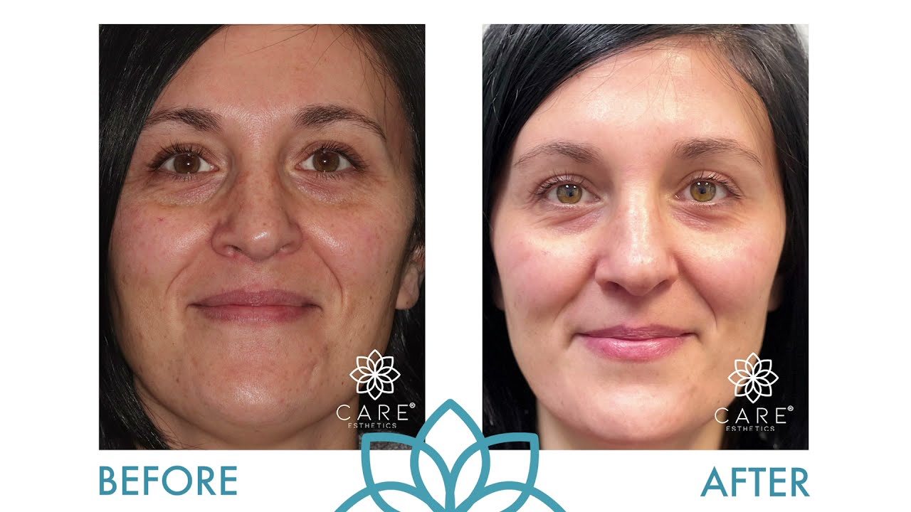 CARE Esthetics clinical demonstration of Microneedling with PRF treatment showing the DermaPen device and PRF application process