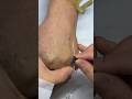 Injection Technique Made Simple | Types of Needle Injections You Need To Know 18