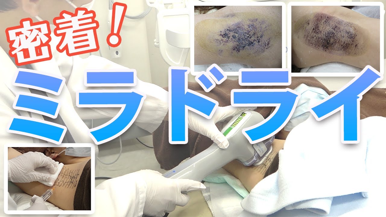 【ワキガ治療】専門医 によるミラドライ 施術!ニオイ と汗 の悩みが解消⁈